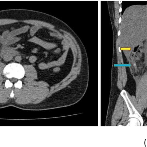 A B Computed Tomography Scans Of The Abdomen The Transverse View