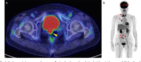 Figure 1 From Response To Lenvatinib And Pembrolizumab Combination