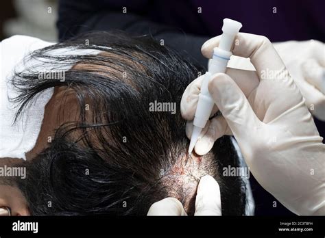 Hair Transplantation Process Pulling Hair Follicles Back And