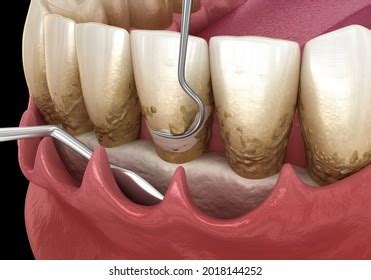 Open Curettage Scaling Root Planing Conventional Stock Illustration