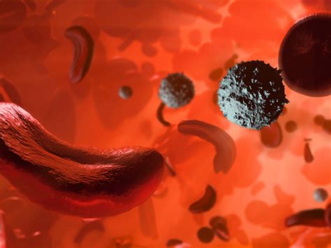 New Gene Therapy Could Provide Cure For Sickle Cell Disease According