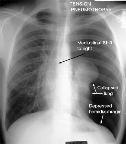 Pneumothorax Flashcards Quizlet