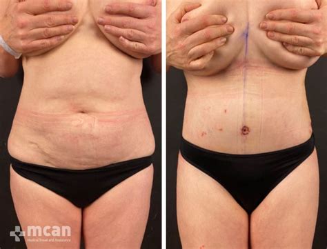 Tummy Tuck Turkey MCAN Health