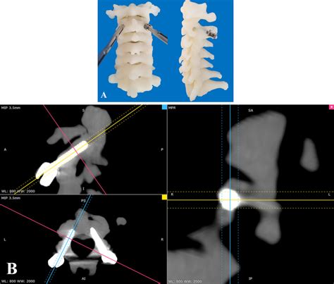 A C2 Pedicle Screws Were Inserted Into 3d Printed Bone Model B