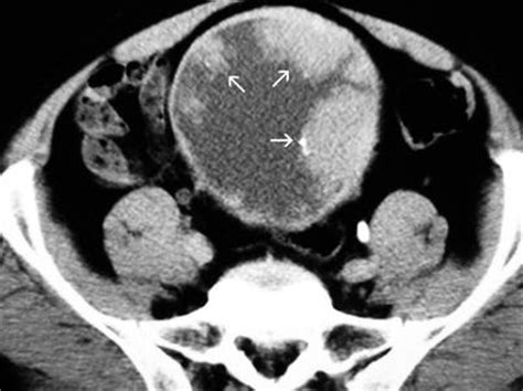 Neoplasms Of The Bladder Radiology Key