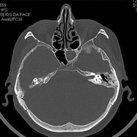 Pdf Differential Diagnosis And Treatment Of Isolated Pathologies Of The Sphenoid Sinus