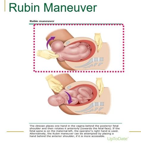 Rubin Maneuver