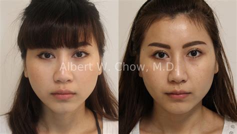 Asian Rhinoplasty In San Francisco Triple Board Certified Plastic