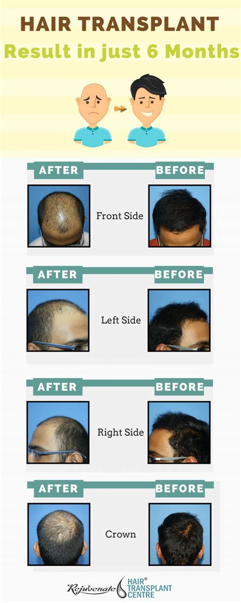 Hair Transplant Result Just In After Months Rejuvenate Hair Hair