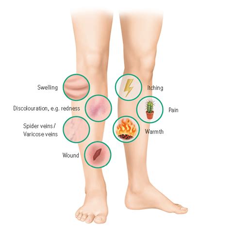 Venous leg ulcers (ulcus cruris venosum) - Juzo