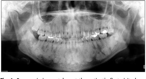 Figure 1 from Gardner Syndrome Showing Multiple Osteomas in the Jaws | Semantic Scholar