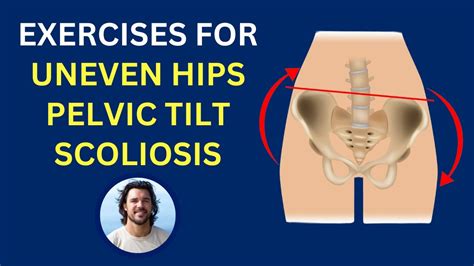 Best Exercises For Uneven Hips Scoliosis Pelvic Imbalance Youtube