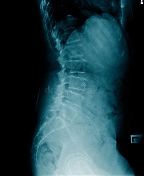 Lateral Abdomen X Ray