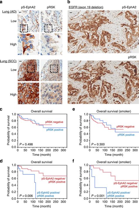 S Epha And Prsk Are Co Localized In Cancer Patients Specimens And The