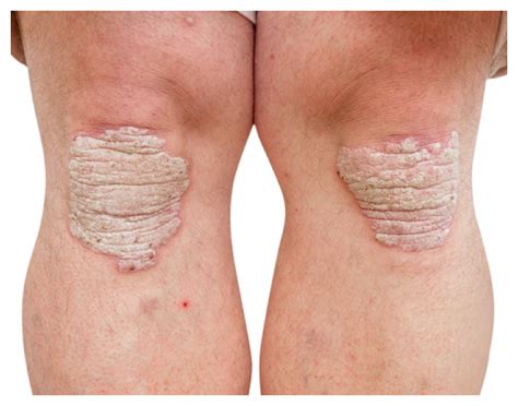 Psoriasis Symptoms: What Does Psoriasis Look Like? | psoriasisSPEAKS