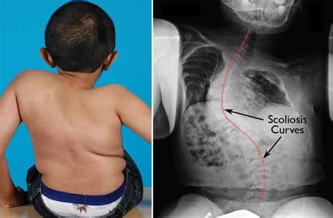 Osteogeneza imperfecta sau boala oaselor de sticlă la copii simptome