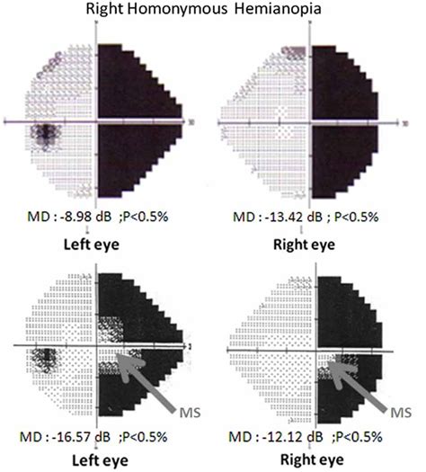 Frontiers Rehabilitation Of Homonymous Hemianopia Insight Into Blindsight