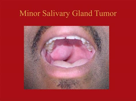 Ppt Physical Diagnosis In Otolaryngology Department Of Otolaryngology