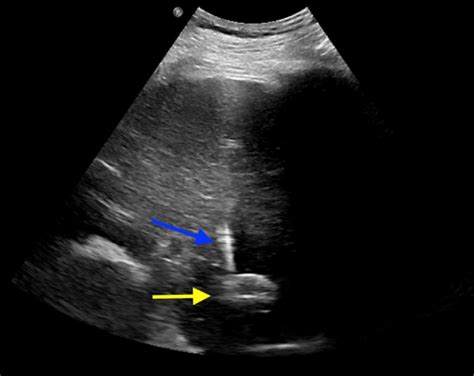 Ultrasound Guided Transhepatic Access Caption Ultrasound Is Used To