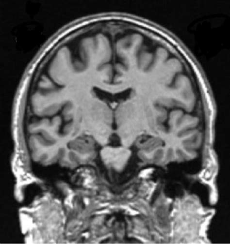 Clinical MRI Brain Scans Will Enrich the Adult Changes in Thought Study ...