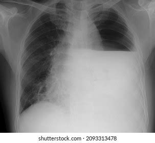 Chest X Ray Hydropneumothorax