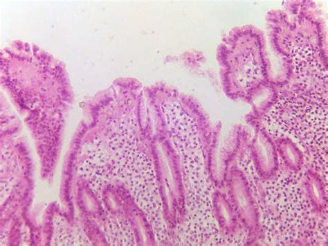 Tumor Thickness Indicates 10-Year Survival for Mucosal Melanoma