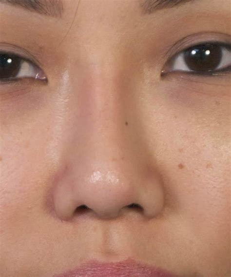 Revision Asian Rhinoplasty In San Diego Ca By Facial Plastic Surgery