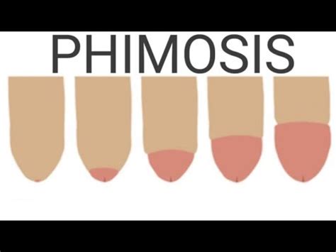 Phimosis Introduction Types Causes Risk Factors Sings Symptoms