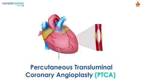 What Is Percutaneous Transluminal Coronary Angioplasty PTCA L