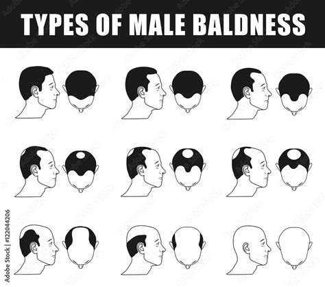 male baldness, type baldness, head baldness, norwood scale, human ...