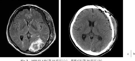 Figure 2 From Spontaneous Acute Subdural Hematoma And Intracerebral