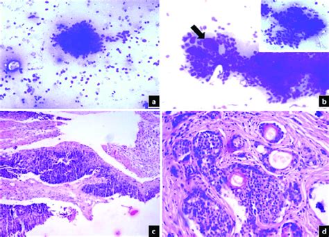 A Cytology Smear Showing Basaloid Cell Cluster With High Nc Ratio