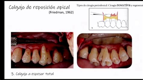 Episodio V Red Sessions Cirugía periodontal resectiva Vs cirugía