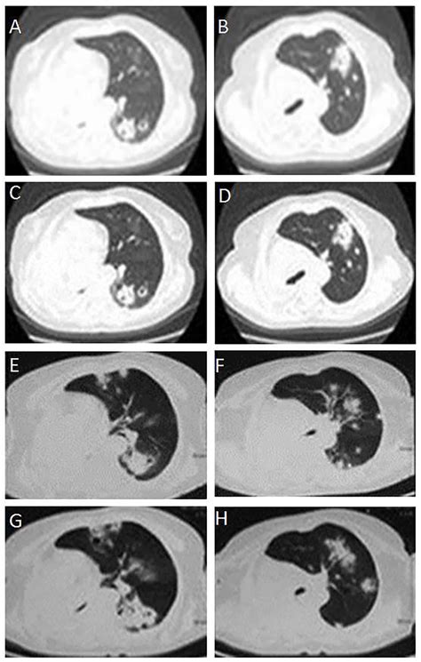 Primary Mucinous Adenocarcinoma Of The Lung A Case Report And Review