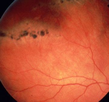 Retinal Detachment