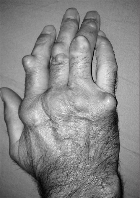 Subcutaneous Nodules Rheumatoid Arthritis