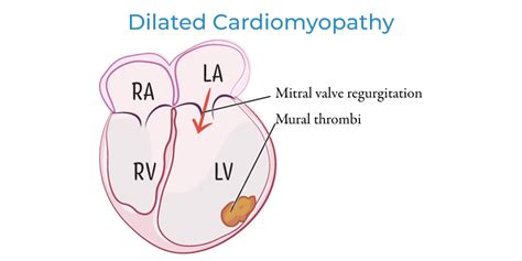 USMLE COMLEX Step 1 Glossary Cardiomyopathies For USMLE Step 1