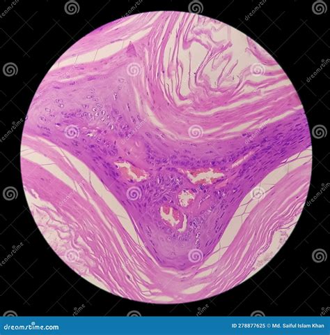 Squamous Hyperplasia Of Right Lower Bucco Areola Stock Image Image Of