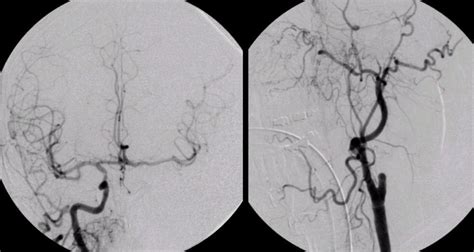 Internal Carotid Artery9