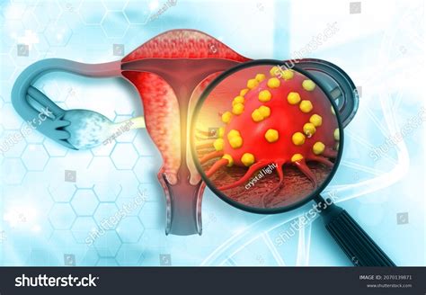 Female Reproductive System Diseases Uterus Cancer Stock Illustration