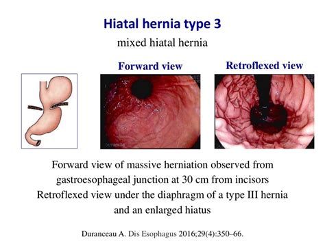 Diagnosis of sliding hiatal hernia