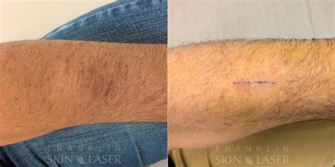 Cyst & Lipoma Removal Before and Afters | Franklin Skin and Laser