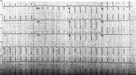 Focal Atrial Tachycardia Ecg Hot Sex Picture