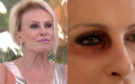 Ana Maria Braga Surge Olho Roxo E N O Esconde Viol Ncia