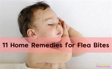 Flea Bites: 11 Effective Home Remedies for Kids | Flea remedies, Home remedies for fleas, Flea bite