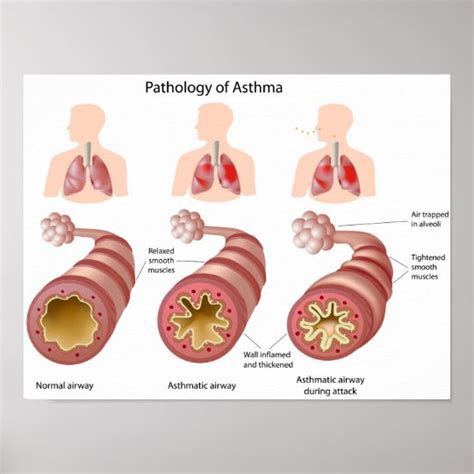 Lung disease Asthma Poster | Zazzle