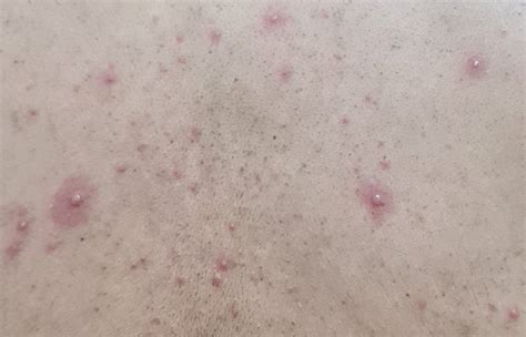 Sars Rash