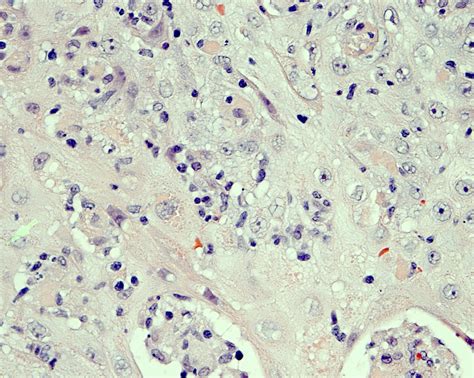 Leishmaniasis Histology