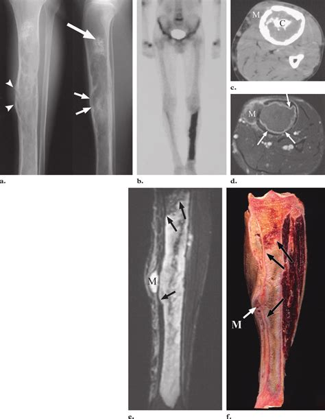 Conventional Intramedullary Chondrosarcoma Of The Tibia In A