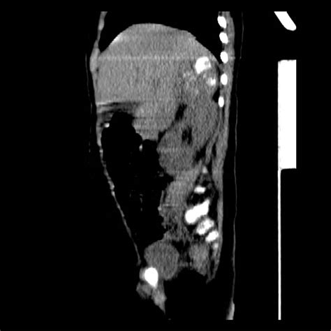 Neuroblastoma With Skull Metastases Image Radiopaedia Org